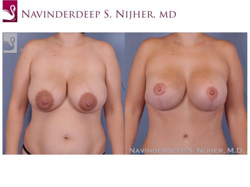 Breast Revisions Case #40869 (Image 1)