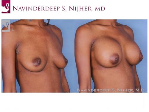 Breast Augmentation Case #55093 (Image 2)