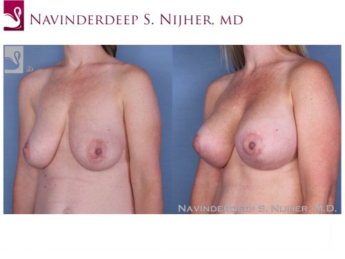 Breast Augmentation with Mastopexy (Breast Lift) Case #37143 (Image 2)