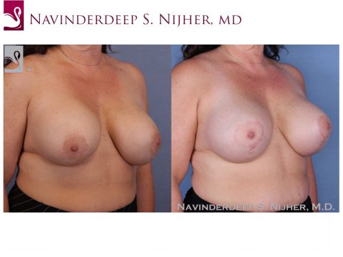 Breast Revisions Case #48262 (Image 2)