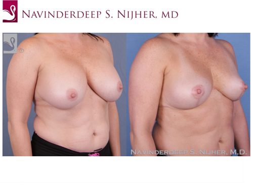 Breast Revisions Case #52739 (Image 2)