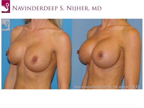 Breast Revisions Case #45044 (Image 2)