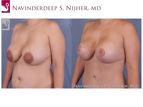 Breast Revisions Case #40869 (Image 2)