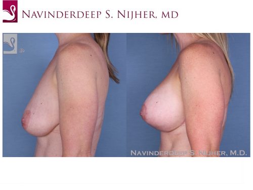 Breast Augmentation with Mastopexy (Breast Lift) Case #37143 (Image 3)