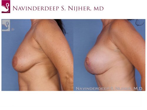 Breast Augmentation with Mastopexy (Breast Lift) Case #20729 (Image 3)