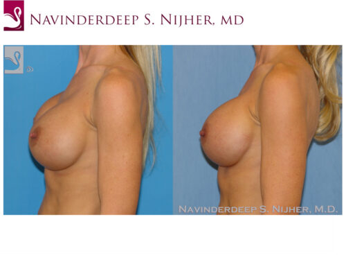 Breast Revisions Case #45044 (Image 3)
