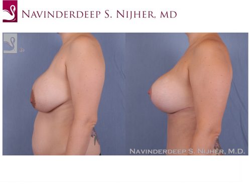 Breast Revisions Case #40869 (Image 3)