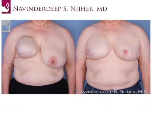 Breast Reconstruction Case #51281 (Image 1)