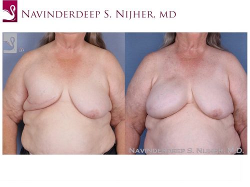Breast Reconstruction Case #50111 (Image 1)
