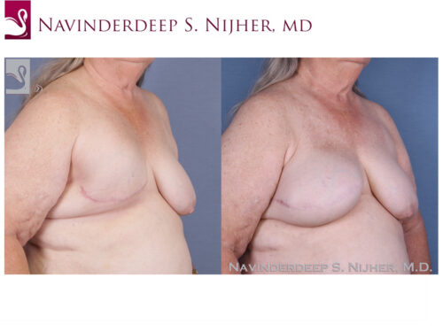 Breast Reconstruction Case #50111 (Image 2)