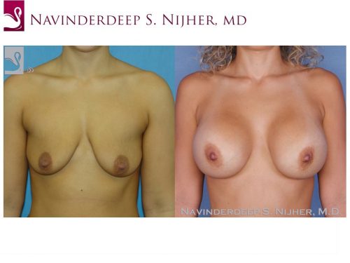 Breast Augmentation Case #40089 (Image 1)