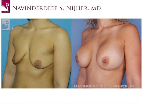Breast Augmentation Case #40089 (Image 2)