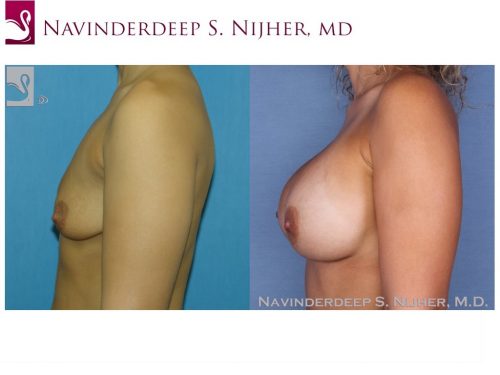 Breast Augmentation Case #40089 (Image 3)