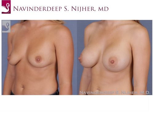 Breast Augmentation Case #51922 (Image 2)
