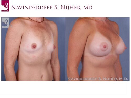 Breast Augmentation Case #50285 (Image 2)