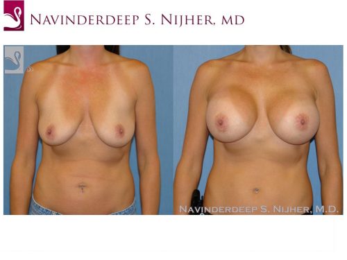 Breast Augmentation Case #48426 (Image 1)