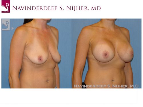 Breast Augmentation Case #48426 (Image 2)