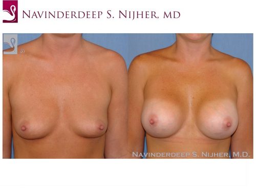 Breast Augmentation Case #21221 (Image 1)