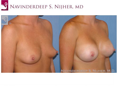 Breast Augmentation Case #21221 (Image 2)