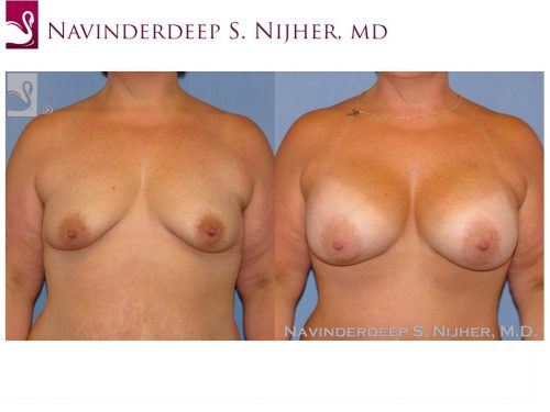 Breast Augmentation Case #8987 (Image 1)
