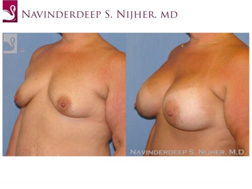 Breast Augmentation Case #8987 (Image 2)