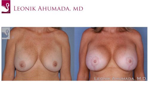 Breast Revisions Case #16792 (Image 1)