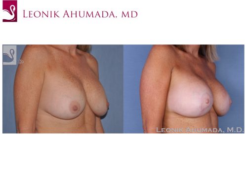 Breast Revisions Case #16792 (Image 2)
