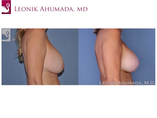 Breast Revisions Case #16792 (Image 3)