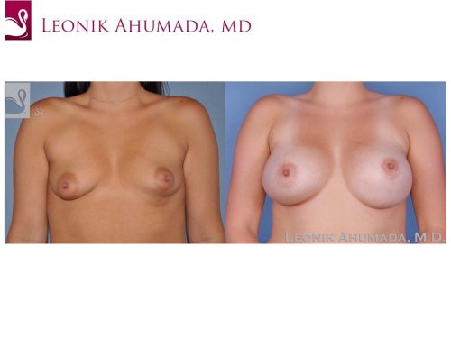 Breast Augmentation Case #24770 (Image 1)