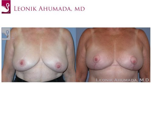 Female Breast Reduction Case #38113 (Image 1)