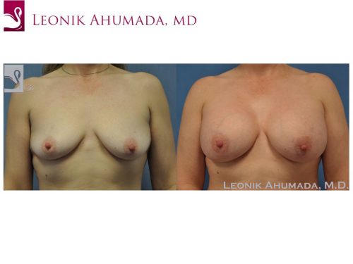 Breast Augmentation Case #40048 (Image 1)