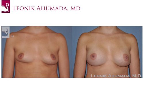 Breast Augmentation Case #47561 (Image 1)