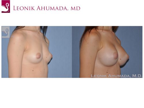 Breast Augmentation Case #49775 (Image 2)