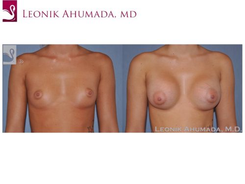 Breast Augmentation Case #50014 (Image 1)
