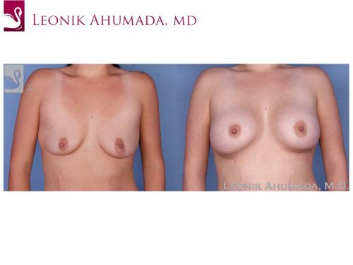 Breast Augmentation Case #52330 (Image 1)