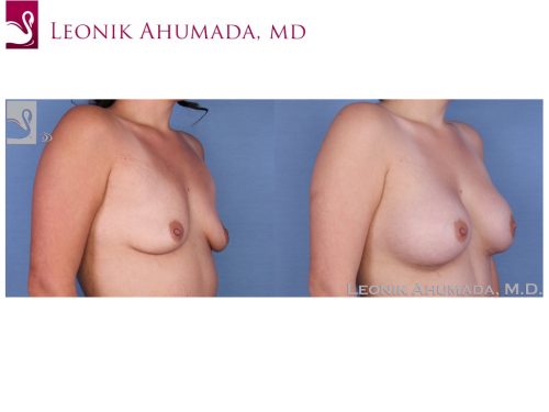 Breast Augmentation Case #52330 (Image 2)