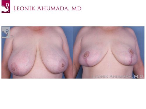 Female Breast Reduction Case #55396 (Image 1)