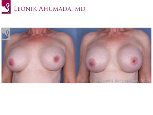 Breast Revisions Case #55422 (Image 1)