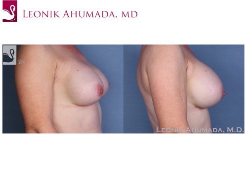 Breast Revisions Case #55422 (Image 3)