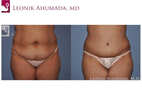 Abdominoplasty (Tummy Tuck) Case #34361 (Image 1)