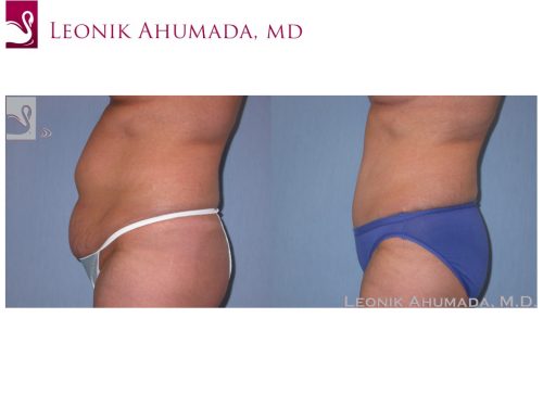 Abdominoplasty (Tummy Tuck) Case #38820 (Image 3)