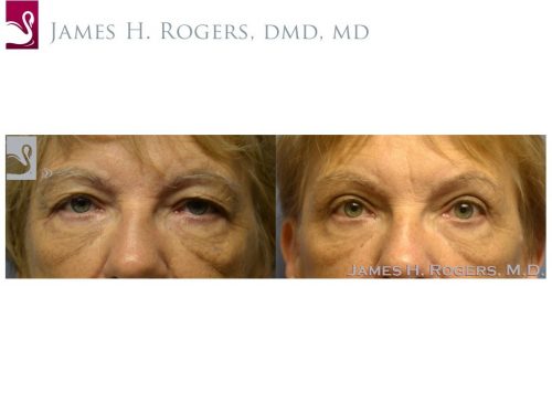 Eyelid Surgery Case #53613 (Image 1)