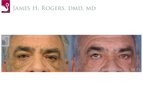 Eyelid Surgery Case #28067 (Image 1)