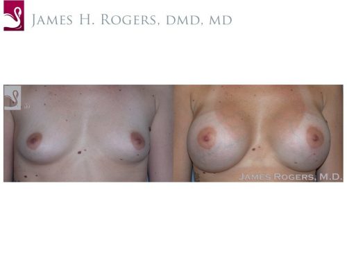 Breast Augmentation Case #29092 (Image 1)
