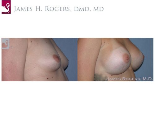 Breast Augmentation Case #29092 (Image 2)