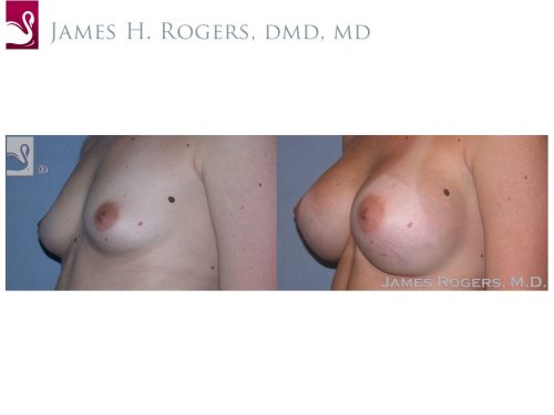 Breast Augmentation Case #29092 (Image 3)
