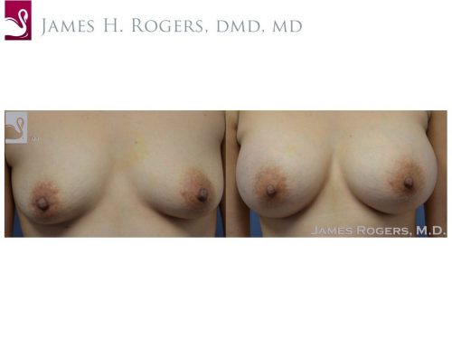Breast Augmentation Case #41307 (Image 1)