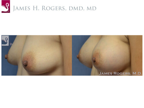 Breast Augmentation Case #41307 (Image 3)