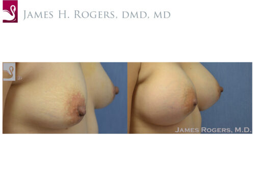 Breast Augmentation Case #41307 (Image 2)