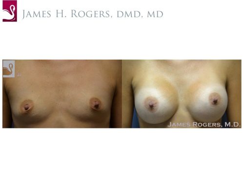 Breast Augmentation Case #50333 (Image 1)